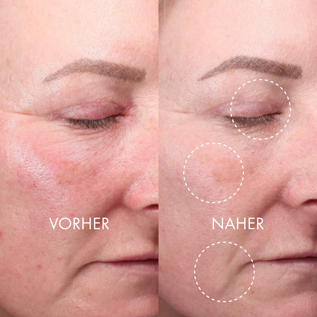 DERMA EXPERT LED Light Treatment